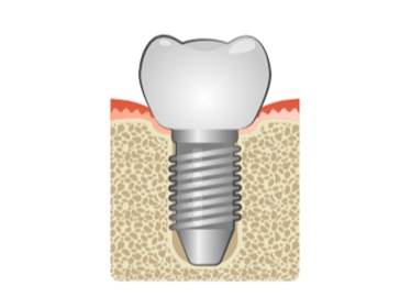 Dental Implants solutions