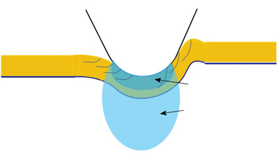 tensile and compressive stresses